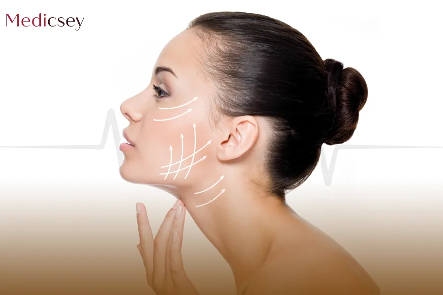 Thread Face Lift Cost in Turkey Medicsey